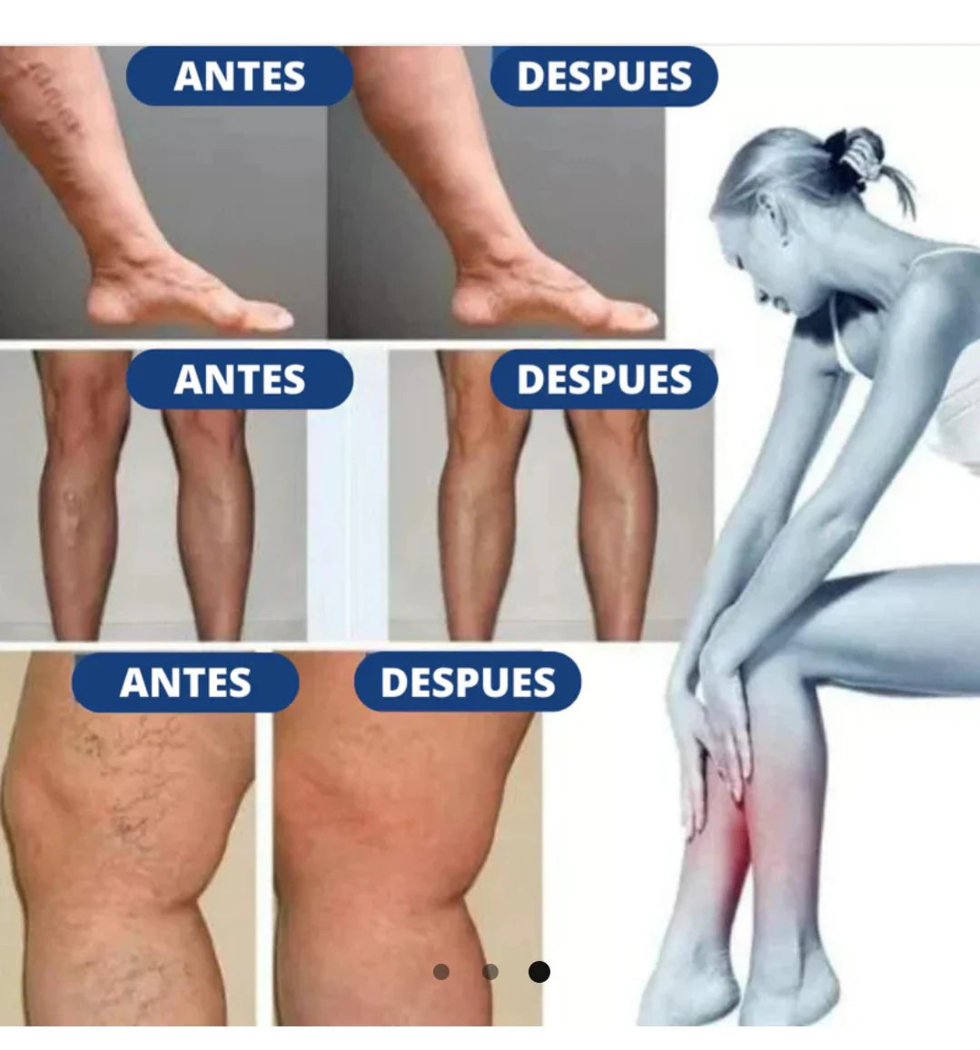 Parches Para Varices